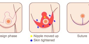 We did not take any photos of the breast reduction, but I thought I would share a similar diagram of the process. Dr. Moorman usually uses the Inferior Pedicle Technique on breast reductions. The left diagram is from the internet and on the right is Dr. Moorman’s own diagram. 